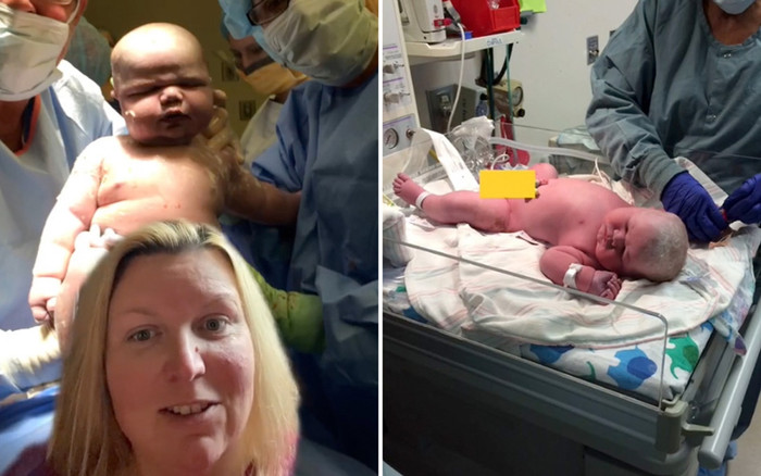 Bé sơ sinh chào đời đã nặng 6,5 kg, gấp 3 trẻ bình thường Ảnh 2