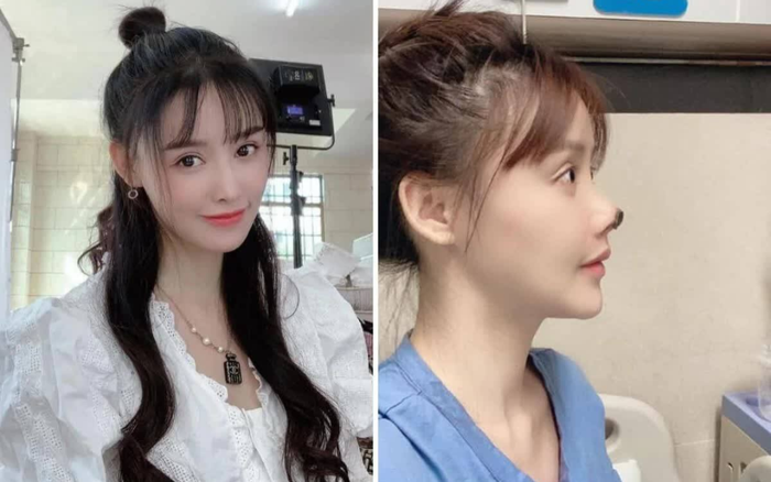 Nữ diễn viên Trung Quốc hoại tử mũi vì phẫu thuật thẩm mỹ khiến cư dân mạng sợ hãi Ảnh 2