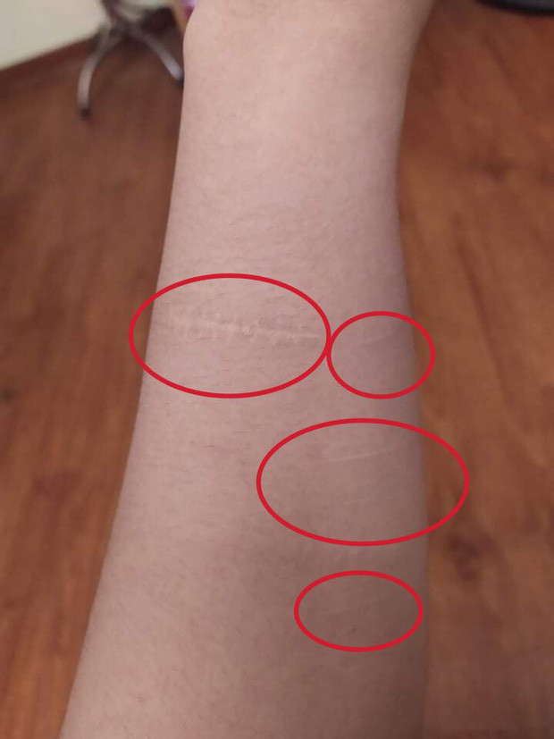 D. nảy ra những suy nghĩ tiêu cực, từng muốn tự tử vì bị T. và nhóm bạn bạo lực tinh thần suốt thời gian dài