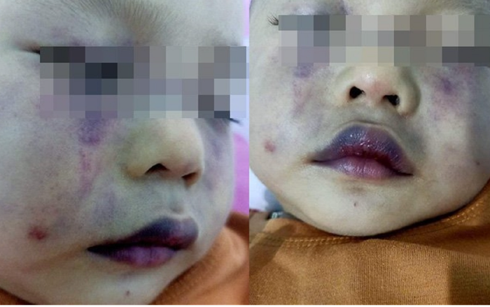 Nghi vấn người phụ nữ ở cơ sở giữ trẻ bạo hành bé trai dã man khiến khuôn mặt bầm dập nặng Ảnh 2