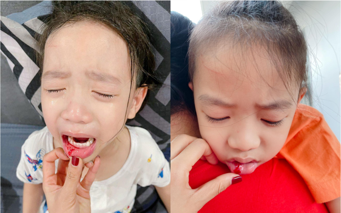 Con trai Ốc Thanh Vân gặp tai nạn chảy máu sưng miệng Ảnh 2