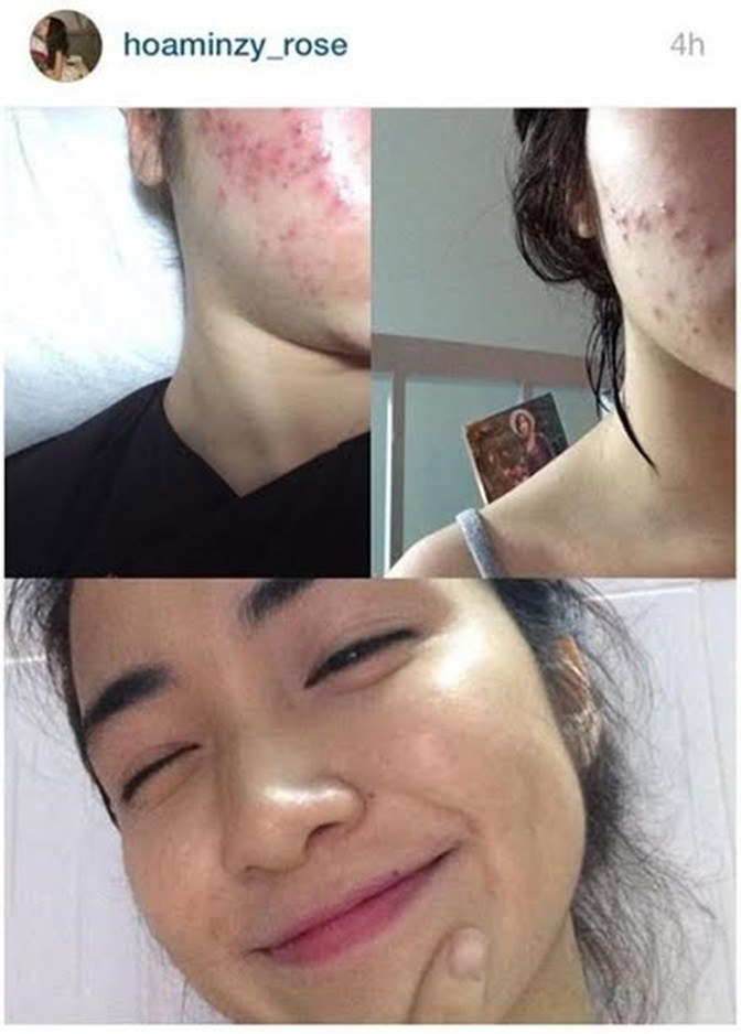 Gương mặt của Hoà Minzy bị nhiều nốt mụn do nội tiết tố...
