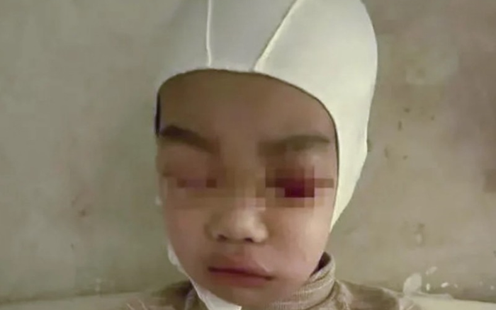 Thầy giáo giật tóc học sinh đến rách da đầu, nứt hộp sọ Ảnh 2