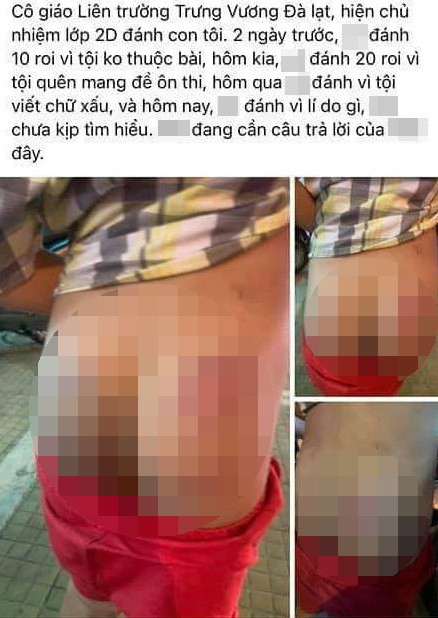 Học sinh bị cô giáo đánh bầm mông khiến nhiều người bức xúc