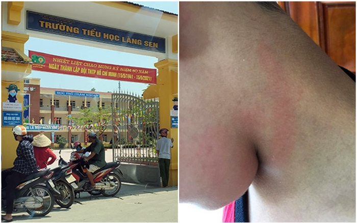 Con ở lớp bị bạn cắn vào tay, mẹ tìm đến tận nhà tát vào mặt một học sinh để 'trả đũa' Ảnh 2