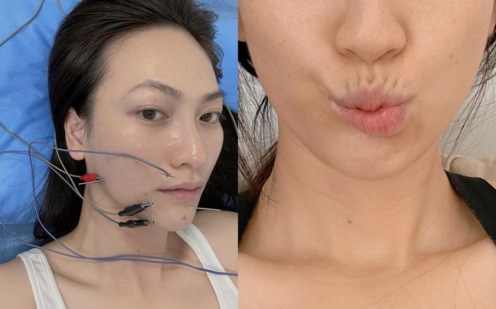 Diễn viên Phương Anh Đào bị lệch méo khung môi sau phẫu thuật tuyến giáp Ảnh 2