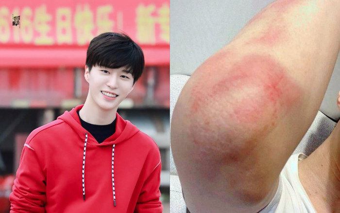 Phạm Thừa Thừa chịu đựng ngã mười mấy lần đến chấn thương để phục vụ cảnh quay trong 'Vai trái có bạn' Ảnh 2