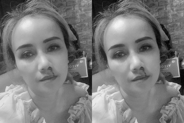 Nữ diễn viên được chẩn đoán gãy xương mũi chính và đang trong thời gian chờ giấy giám định thương tật.