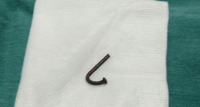 Cây đinh dài 3 cm được lấy ra khỏi mắt.