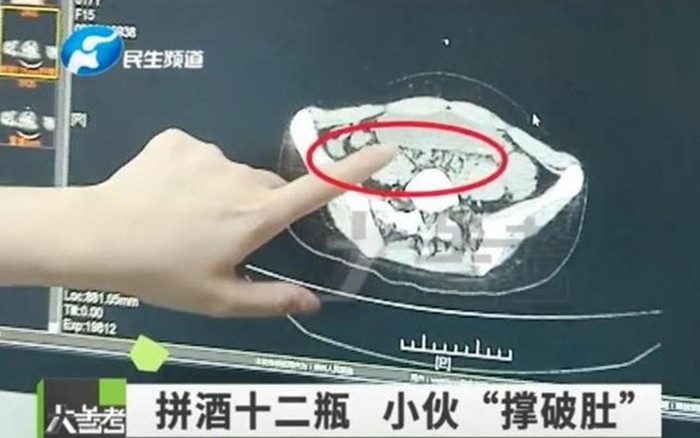 'Nốc' 12 chai bia bị đau bụng dữ dội, nam sinh 17 tuổi sợ xanh mặt khi nhìn kết quả chụp phim Ảnh 2