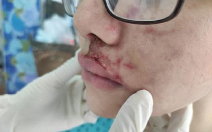 Hà Nội: Cô gái 24 tuổi bị nhiễm trùng vùng mặt nghiêm trọng sau 3 năm tiêm filler Ảnh 2