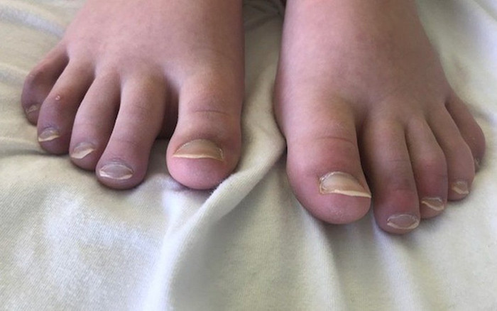 Bé gái mắc chứng bệnh 'Ngón chân Covid-19' dù chưa từng xét nghiệm dương tính nCoV Ảnh 2