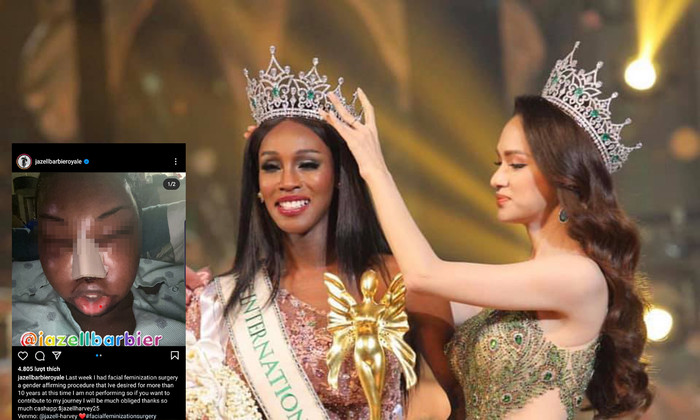 Gương mặt sưng phù do vừa trải qua một cuộc đại phẫu...