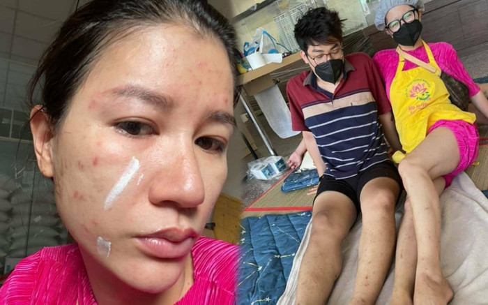 Trang Trần bị dị ứng, mọc đầy vết thâm, ghẻ khi đi làm từ thiện nhưng thái độ mới đáng nể phục Ảnh 2