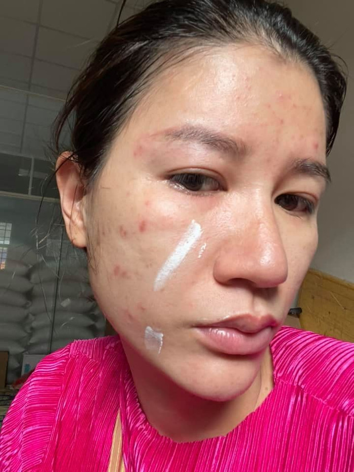 Dù phải mấy tháng nữa, làn da mới được cải thiện nhưng xem ra, người đẹp không hề lo lắng chút nào.