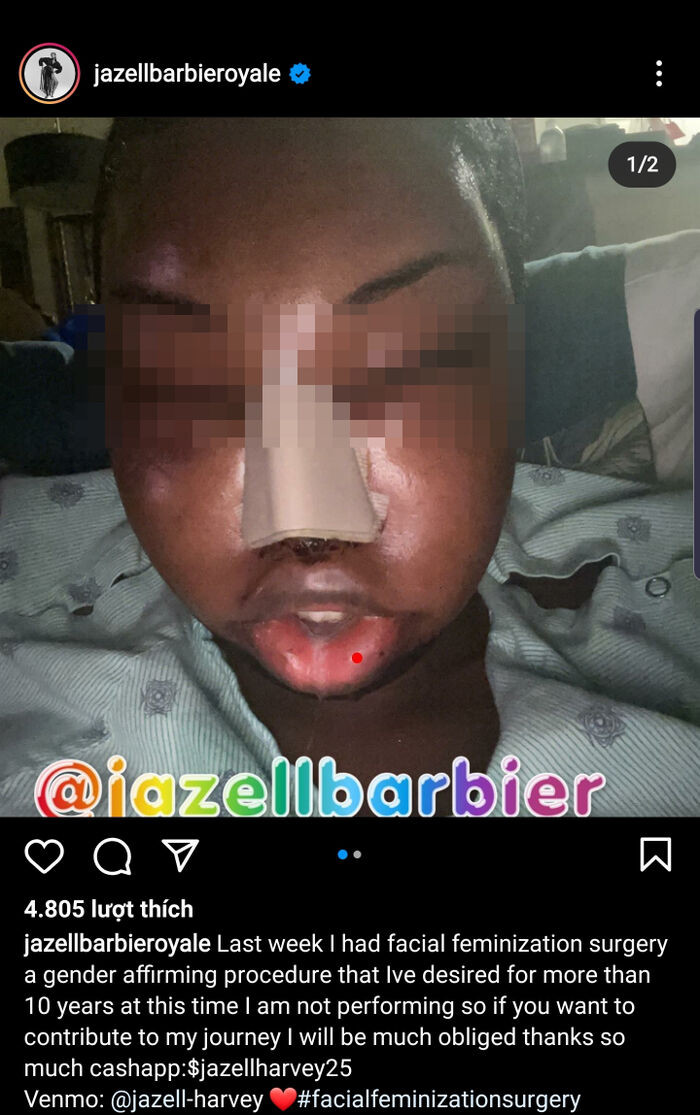 Hồi cuối tháng 7 vừa qua, người đẹp khiến fan bất ngờ khi công khai gương mặt sưng húp sau cuộc đại phẫu, trùng tu toàn bộ. Được biết, số tiền thực hiện phẫu thuật là do fan quốc tế quyên góp. 