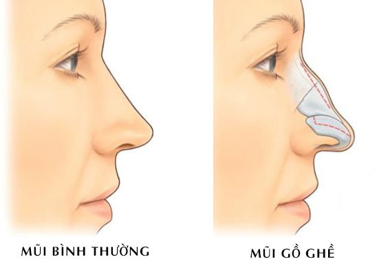 Phụ nữ có sống mũi gồ, gấp khúc thường có số phận vất vả, lận đận đường tình duyên.