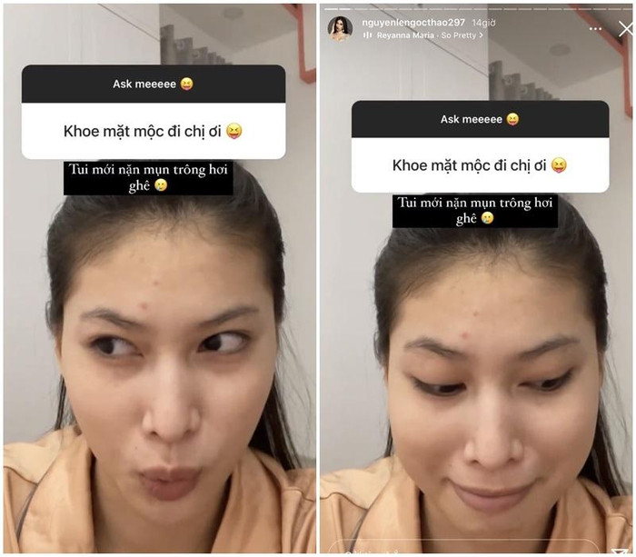 Cô nàng cho biết, mình vừa nặn mụn nên còn sưng, tấy, ngoài ra, nhiều người cũng thấy đôi môi nàng Á hậu có chút thâm, phần quầng mắt lộ rõ...