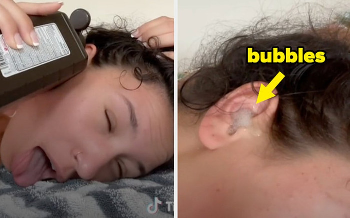 Cảnh báo trào lưu đổ oxy già vào tai trên TikTok Ảnh 2