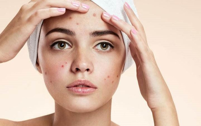 Tưởng xem clip nặn mụn chỉ đem lại sự kinh dị, thế nhưng thói quen này lại rất tốt cho sức khỏe Ảnh 2