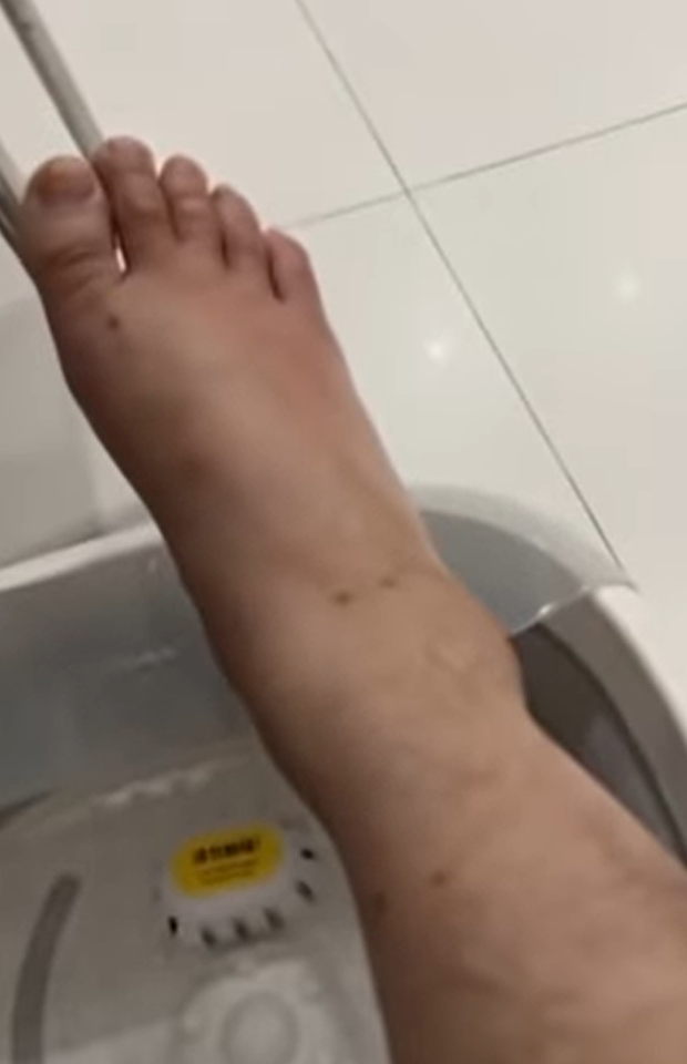 Chân của nam nghệ sĩ sưng vù