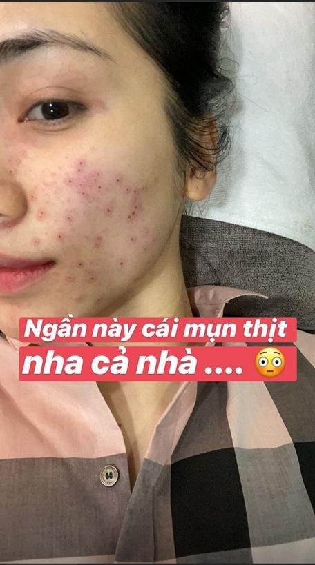 Số lượng nốt mụn được bắn laser khá nhiều khiến gương mặt người đẹp trông chi chít vết đỏ, sẹo... do mụn thịt không có cồi, không nặn được nên muốn huỷ chỉ có thể sử dụng cách này. 