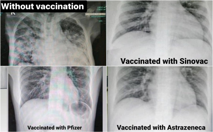 Muốn biết hiệu quả của các loại vaccine ra sao, nhìn phổi của bệnh nhân Covid-19 là biết Ảnh 2