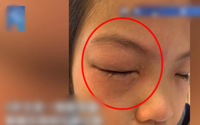 Bé gái bị dị ứng với bài tập Toán, cứ ngồi vào bàn là ngứa ngáy phát khóc, mắt sưng húp lên Ảnh 2