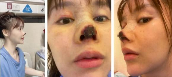 Vì phẫu thuật thẩm mỹ hỏng nên phần mũi của Cao Lưu đã bị hoại tử. 