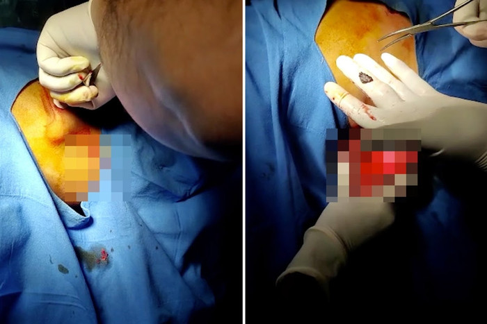 Người đàn ông bị đạn bắn xuyên qua da trong lúc đang ngủ. 