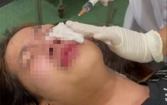 Trêu ghẹo không thành, thanh niên xịt hơi cay vào mắt và hành hung nữ sinh lớp 9 Ảnh 2