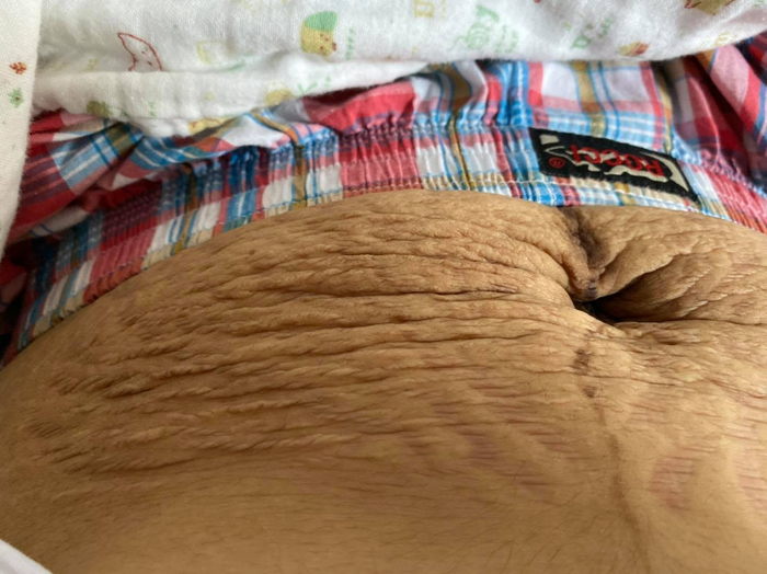 Hình ảnh vòng bụng sau sinh vài tháng. 