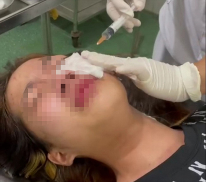 Nữ sinh V. bị tổn thương vùng mắt sau vụ việc