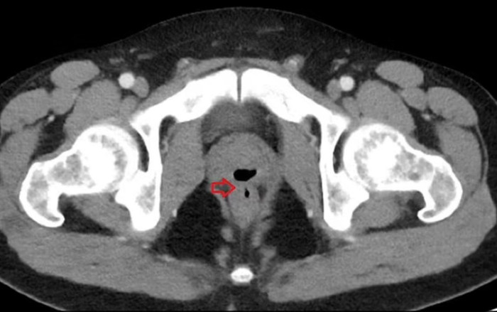 Người đàn ông xuất tinh qua hậu môn và tiểu ra chất thải suốt 2 năm, bác sĩ phát hiện sự thật kinh hoàng Ảnh 2