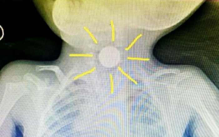 Bé trai 3 tuổi nuốt phải viên pin cúc áo khiến thực quản bị bỏng nặng Ảnh 2