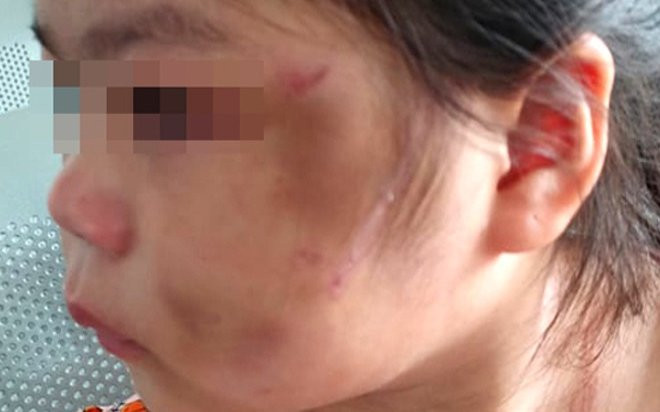 Bé gái 6 tuổi bầm tím mặt mày vì cha ruột 'lỡ tay' khi dạy con học online Ảnh 2