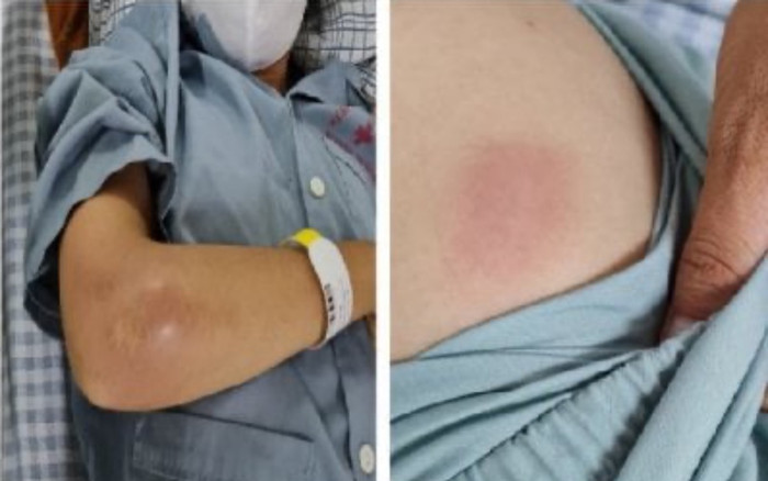 Cô gái sưng đau 'vòng một' đi cấp cứu tại bệnh viện được phát hiện bị 'vi khuẩn ăn thịt người' tấn công Ảnh 2