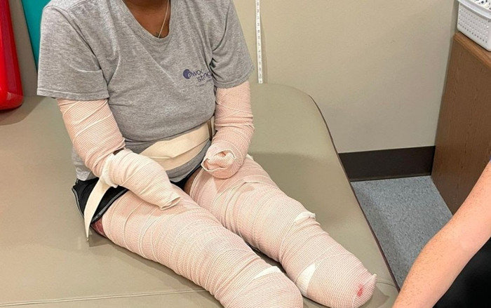 Người phụ nữ bị cắt cụt tứ chi do biến chứng do Covid-19 Ảnh 2