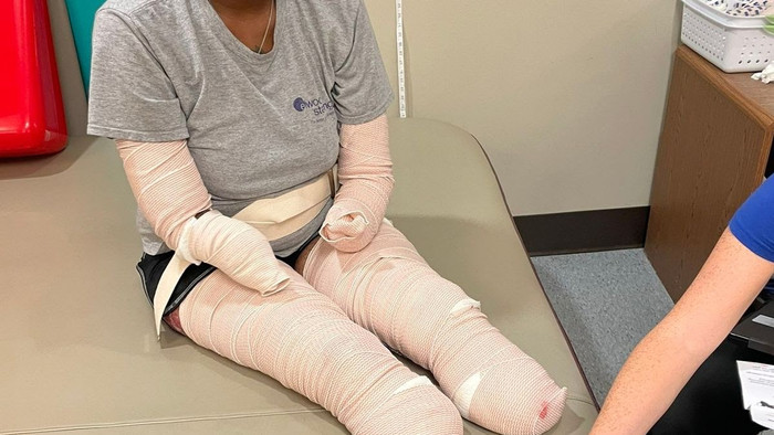 Người phụ nữ bị cắt cụt tứ chi do biến chứng do Covid-19 Ảnh 3