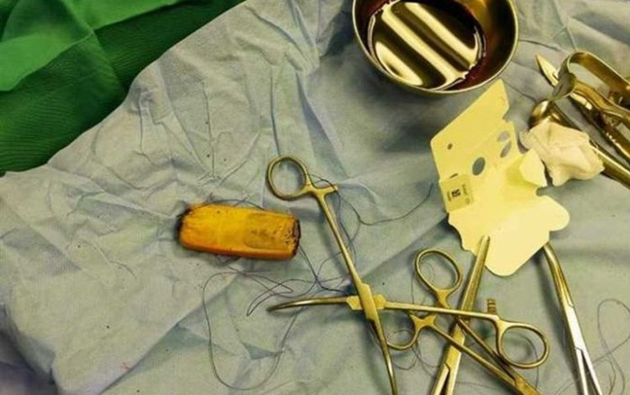 Sống sót kỳ diệu với chiếc điện thoại di động nuốt vào bụng 6 tháng Ảnh 2