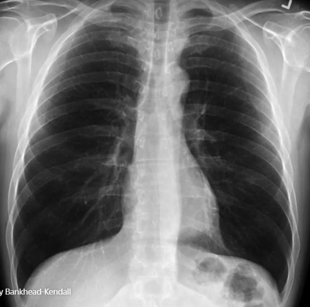 Lá phổi của người khỏe mạnh.