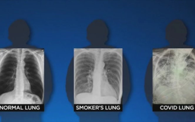 Sốc trước ảnh chụp X-quang phổi của bệnh nhân Covid-19 so với phổi của người hút thuốc Ảnh 2