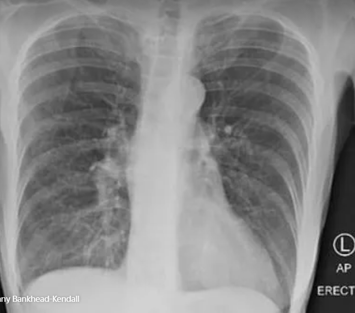 Lá phổi của người nghiện thuốc lá.