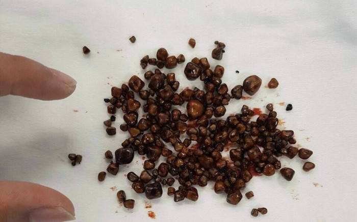 Bị đau bụng 3 ngày không hết, nữ bệnh nhân nhập viện thì được phát hiện hơn 200 viên sỏi trong túi mật Ảnh 2