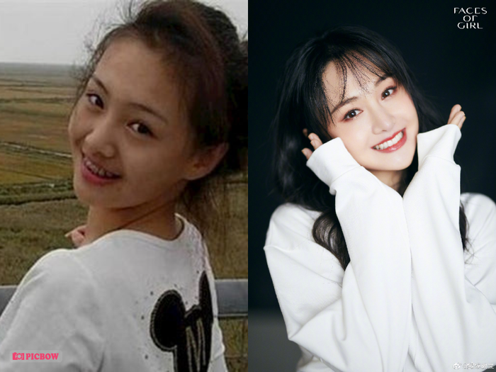 Trịnh Sảng trước khi vào showbiz cũng từng sở hữu hàm răng kém đẹp. Không chỉ xỉn màu, răng của Trịnh Sảng khi ấy còn khá thưa. Nụ cười của cô vì thế cũng trở nên mất tự tin. 