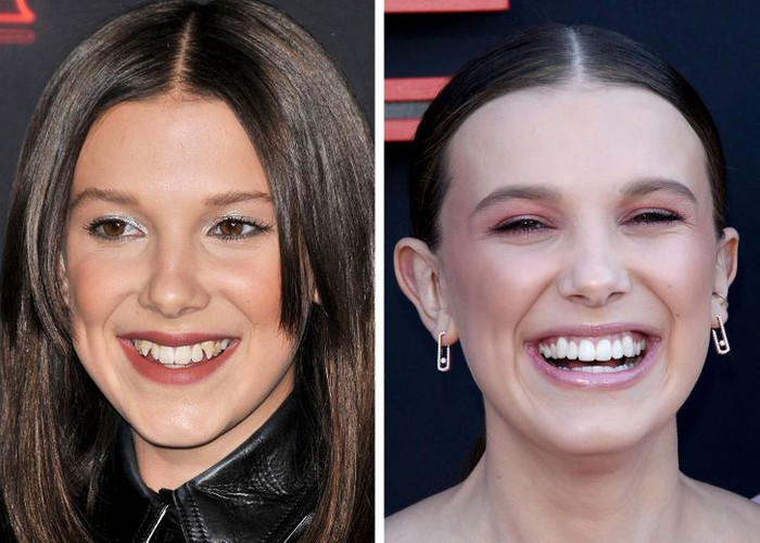 Hàm răng nguyên thủy của Millie Bobby Brown là ác mộng đối với tiêu chuẩn ‘Nụ cười Hollywood’. 