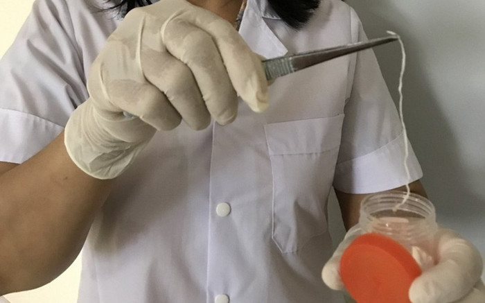 Người đàn ông bị giun rồng ký sinh trong đùi sau nhiều năm 'nghiện' tiết canh và các món tái sống Ảnh 2