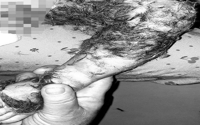 Kinh hoàng thầy lang dùng lông động vật chữa bỏng cho bé 8 tháng tuổi Ảnh 2