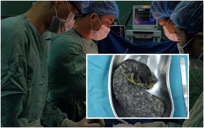 Búi tóc nặng nửa ký nằm trong dạ dày bé gái 7 tuổi ở Quảng Ngãi Ảnh 2