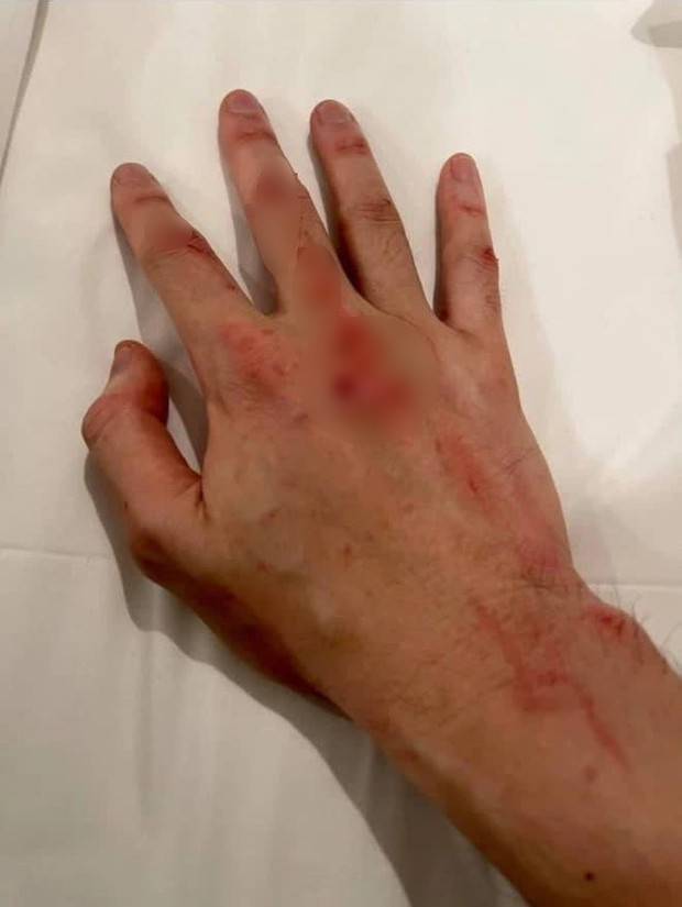 Karik đăng bàn tay đầy máu giữa lúc vướng nghi ngờ hẹn hò, phản ứng của Quỳnh Lương càng bất ngờ hơn Ảnh 3